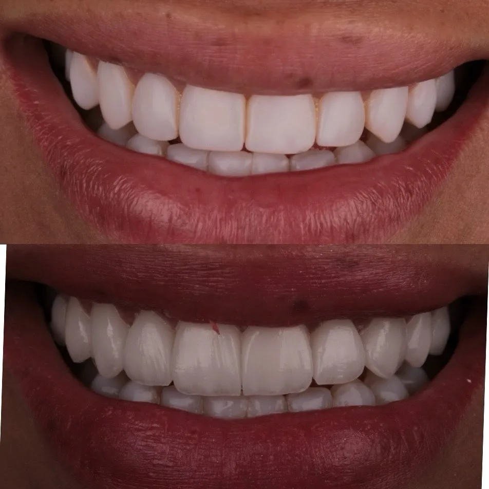 Antes e depois — sorriso com facetas dentárias