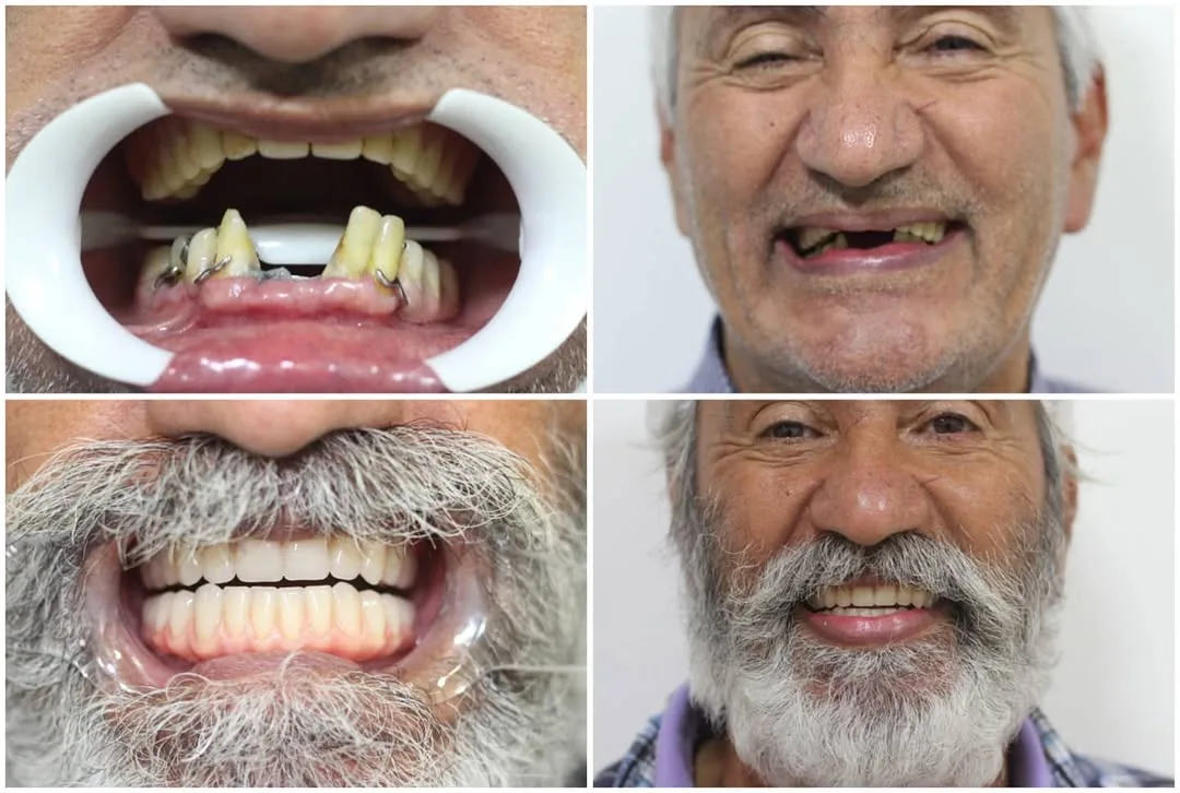 Paciente real após reabilitação com implantes