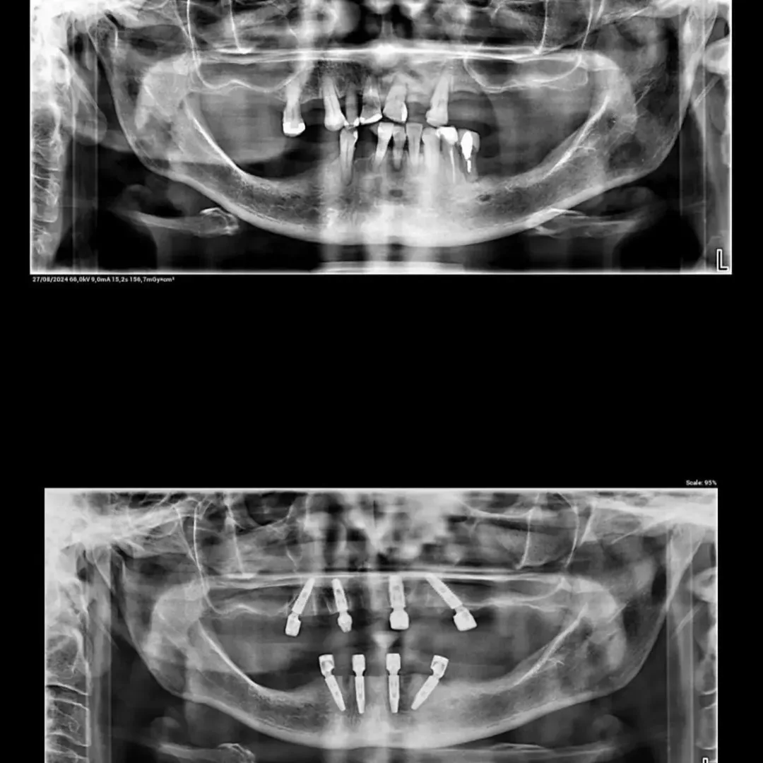 Raio-X panorâmico antes e depois da instalação dos implantes